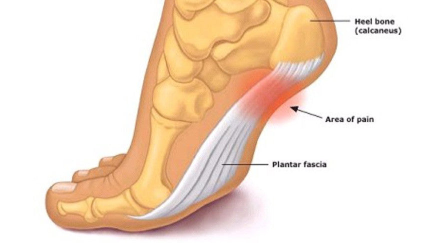 Causes and Treatment of Plantar Fasciitis